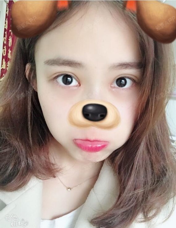 【武汉蜜司医疗美容,术后30天,切开双眼皮 开内眼_圈子-新氧美容整形