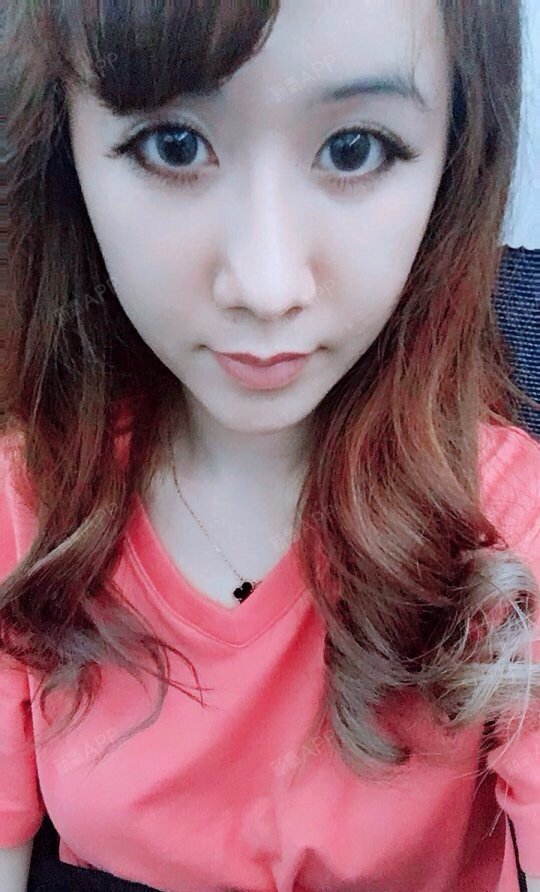 南昌切开双眼皮好不好_效果图_氧气mtf21cf切开双眼皮术后第39天_新氧