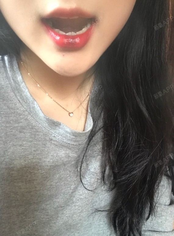 北京玻尿酸丰唇好不好_效果图_前世有约7玻尿酸丰唇术后第2天_新氧