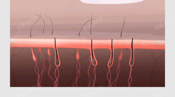 脱毛不是以毛发量多少决定治疗次数的,根据毛发生长周期,每次激光脱毛