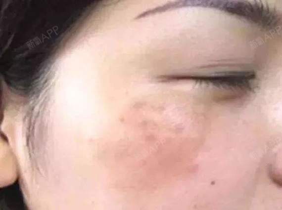 前几日有位来院患者咨询说:"医生,我脸上的黄褐斑怎么这么顽固,用了