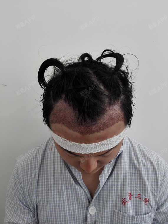 刚做完手术,满头包着纱布,之前也看过很多氧气们发的_圈子-新氧美容