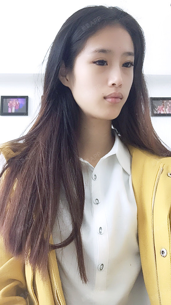 做完面部吸脂这么久了,之前有些担心的问题都没出现