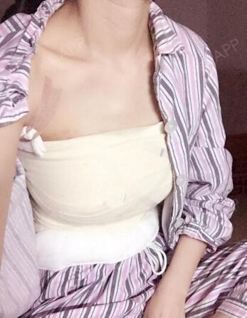广州美贝尔活力脂肪种植乳雕
