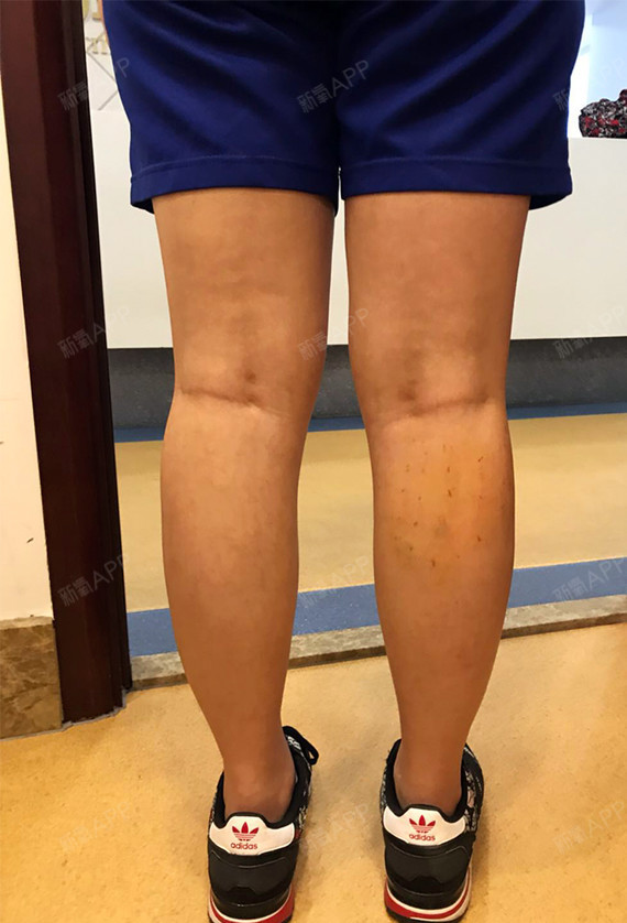 新氧- 花恋叶也恋花 | 瘦脸 | 肉毒素瘦小腿 | 肉毒素 | 术后当自强