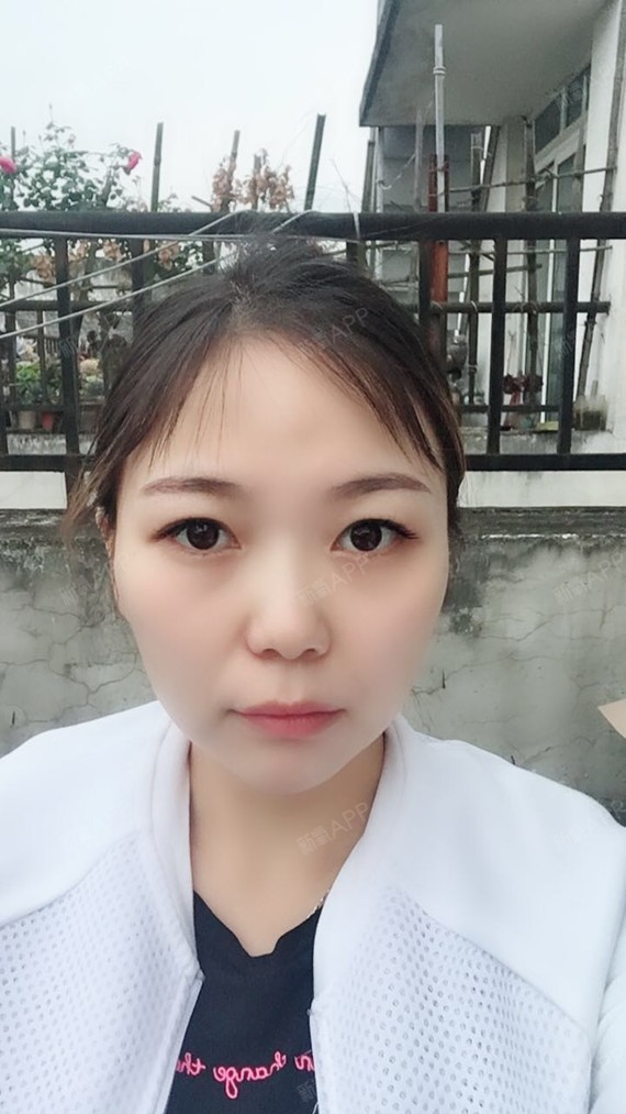 注射瘦脸好不好_效果图_氧气cnbd1c8注射瘦脸术后第8天_新氧美容整形