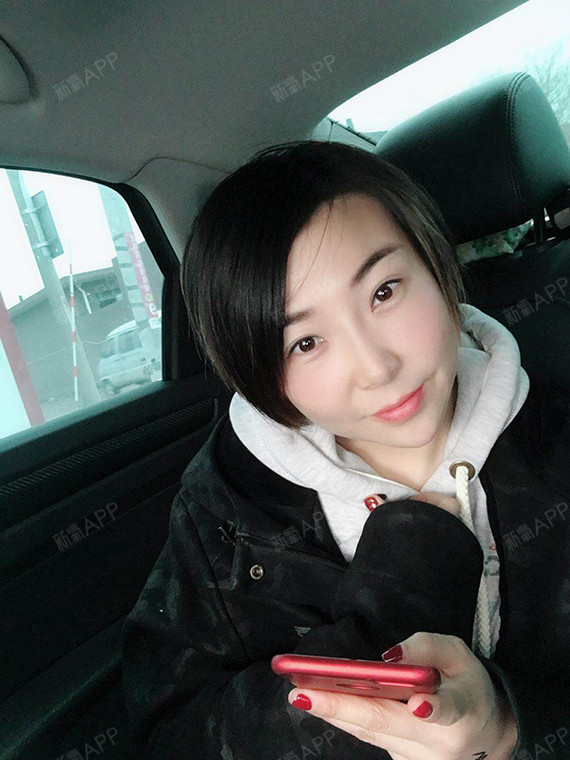 埋线提升好不好_效果图_何梅梅埋线提升术后第15天_新氧美容整形