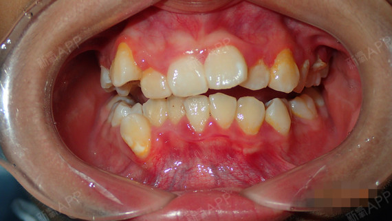 上牙真的很拥挤还有牙齿重叠在一起