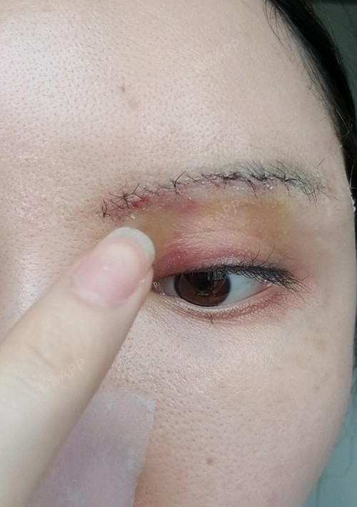 上海切眉术好不好_效果图_文文9045切眉术术后第1天_新氧美容整形