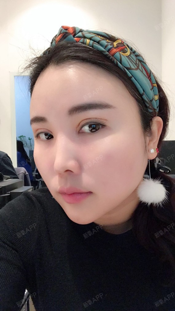 埋线双眼皮