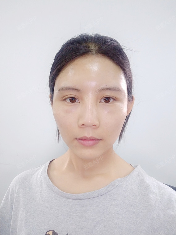 【自体脂肪全脸填充第5天】脂肪填充后能够促进我们的_圈子-新氧美容