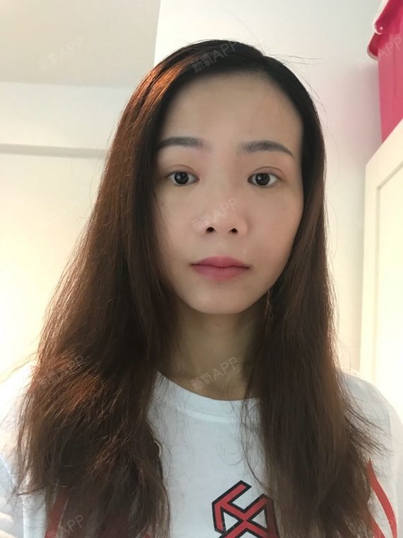 手术19天,做的新月型双眼皮.现在还有点肿,不敢化_圈子-新氧美容整形