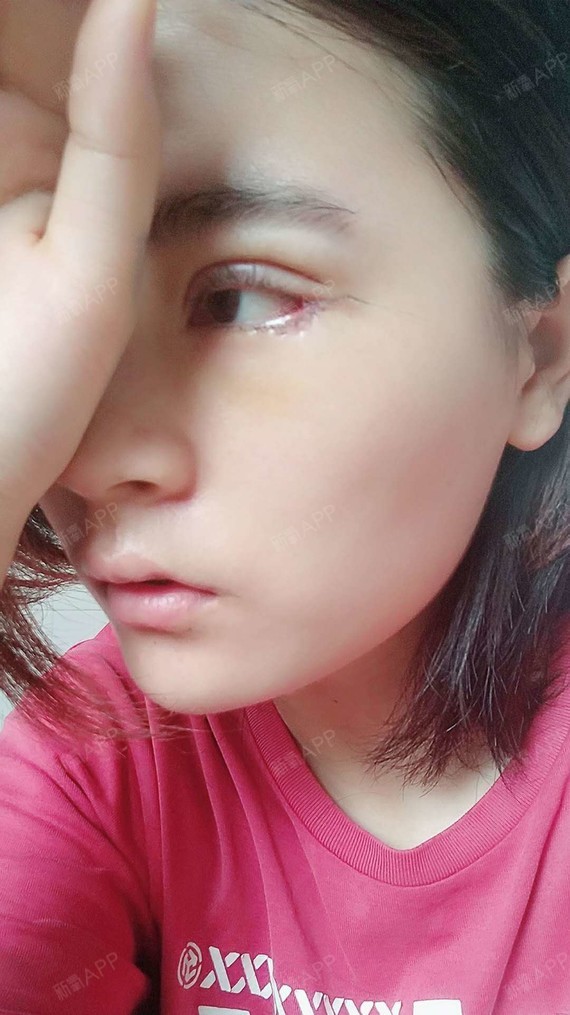 深圳开外眼角好不好_效果图_氧气nnf4c4b开外眼角术后第4天_新氧美容