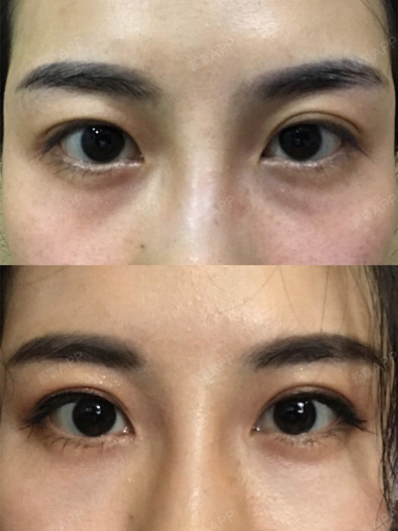 打完眼周胶原针两天,效果就已经很明显了,下面放了张_圈子-新氧美容