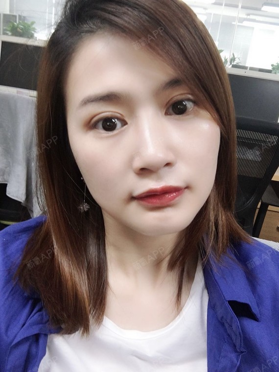 不知不觉的做双眼皮已经一个月了,恢复的不错吧,现在_圈子-新氧美容