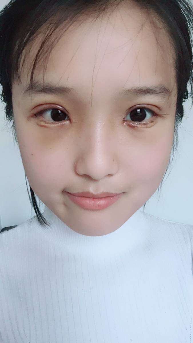 开内眼角怎么样_恢复过程_效果如何_宁静思纬钦仰整形日记3.