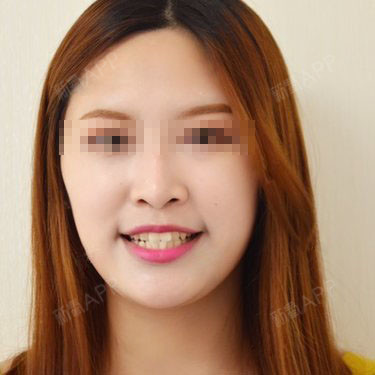 上海隐形矫正好不好_效果图_匿名用户隐形矫正术后第0天_新氧美容整形