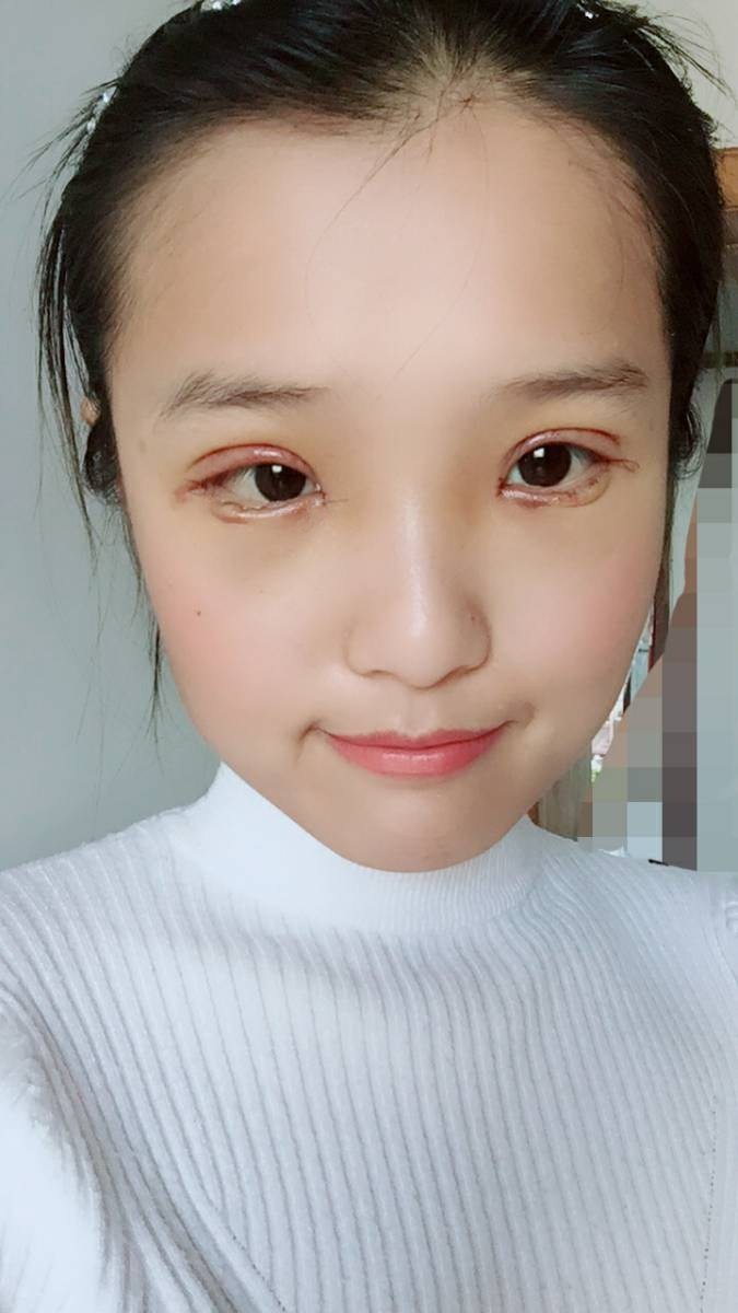 开内眼角怎么样_恢复过程_效果如何_宁静思纬钦仰整形日记3.