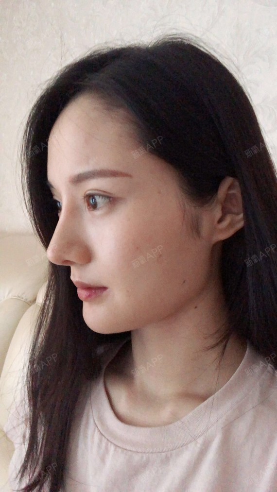 鼻部多项好不好_效果图_好奇番茄鼻部多项术后第167天_新氧美容整形