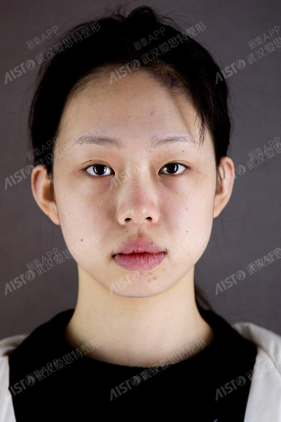 新氧- 爱臭美的小丫头 | 自体脂肪填充全脸 | 术