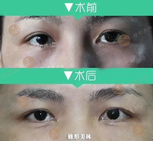 脂肪能填充泪沟吗_填充脂肪能泪沟消肿吗_填充脂肪泪沟出现两条杠