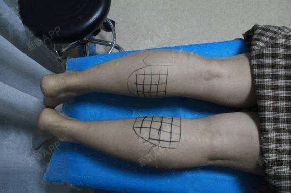 新氧- 氧气xse34 | 瘦脸 | 肉毒素瘦小腿 | 肉毒素 | 术后当自强