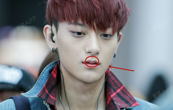 【医师解读:什么是玻尿酸丰唇?】