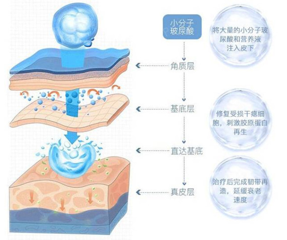 無針水光和有針水光哪個更勝一籌