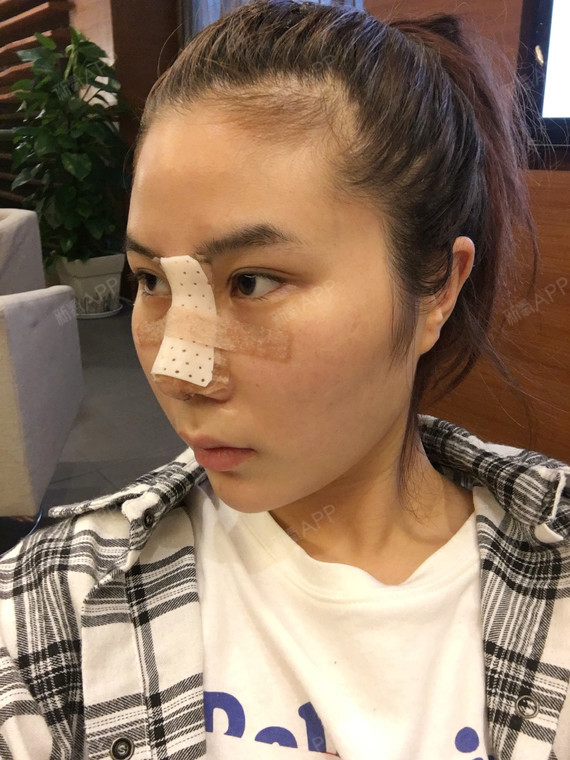 鼻部修复的方法介绍_修复鼻部毛囊的药_鼻部修复