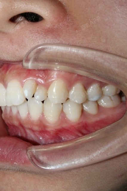 我的牙齿有颗多生牙,因为害怕后面会长大,把旁边的牙_圈子-新氧美容