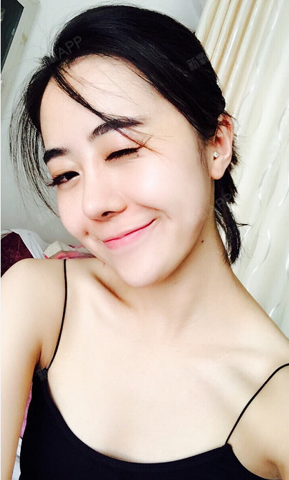 长沙注射瘦脸好不好_效果图_兰谷寿注射瘦脸术后第7天_新氧美容整形