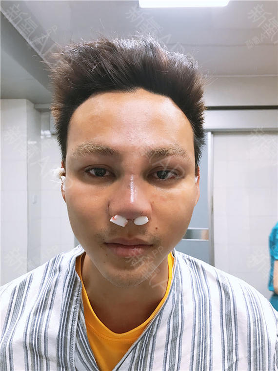 刚做完手术的第一个晚上,鼻子里边塞着止血棉,只能