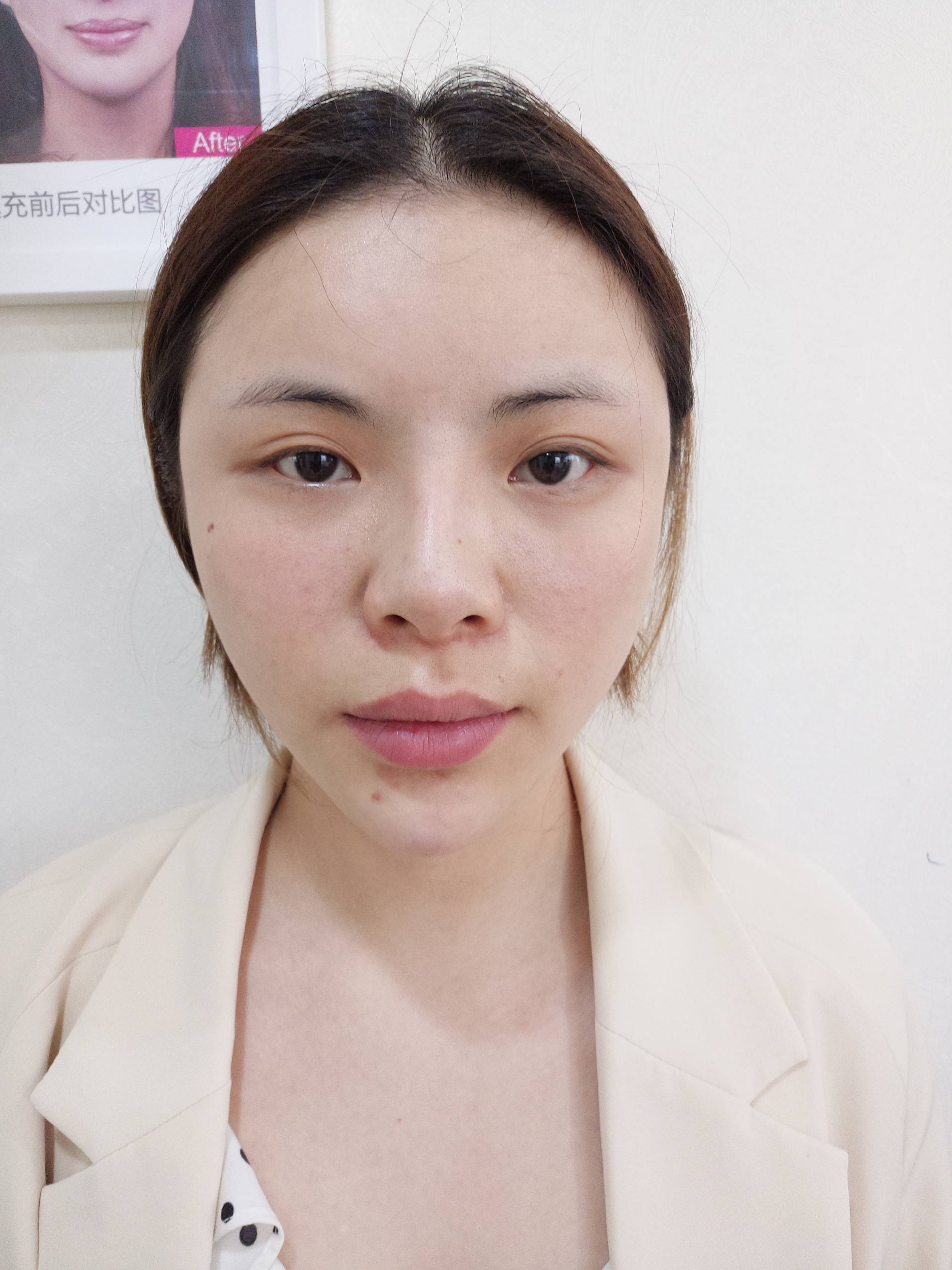 玻尿酸垫的下巴效果很不错