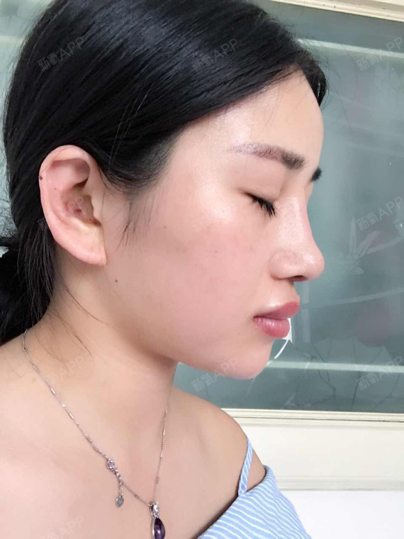 大连膨体隆鼻好不好_效果图_七菇凉0膨体隆鼻术后第20天_新氧美容整形