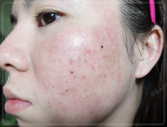 上海点阵激光好不好_效果图_花费点阵激光术后第68天_新氧美容整形