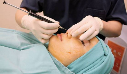 做完线雕隆鼻会肿几天,做了线雕鼻怎么消肿块你做对了_圈子-新氧美容