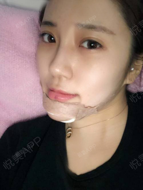 新氧- 氧气xvyuc | 面部轮廓 | 硅胶垫下巴 | 术后当自强 | 金华同城