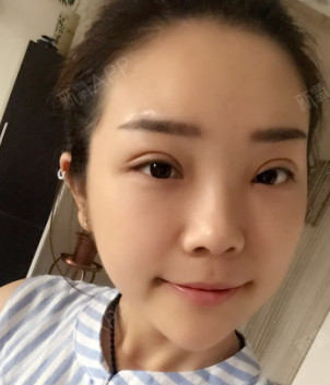 全切双眼皮二十来天的时候的样子,看起来还是有点不自_圈子-新氧美容