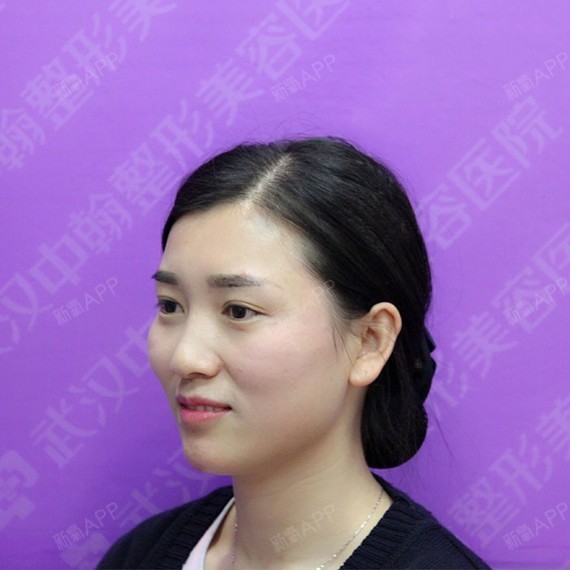 打玻尿酸填充太阳**_打玻尿酸填充太阳**_打玻尿酸填充太阳**
