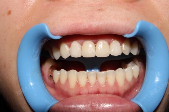 全瓷牙好不好_效果图_芯儿123全瓷牙术后第8天_新氧美容整形