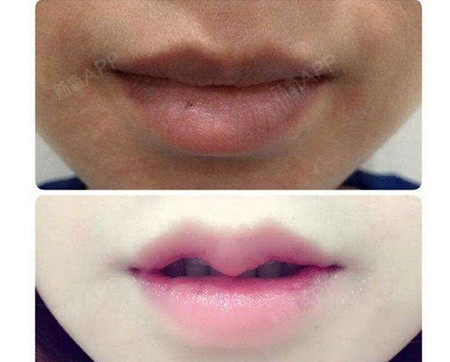 「马蹄唇」兽系奇葩整容潮掀起,医生们都无可奈何地拒绝了!