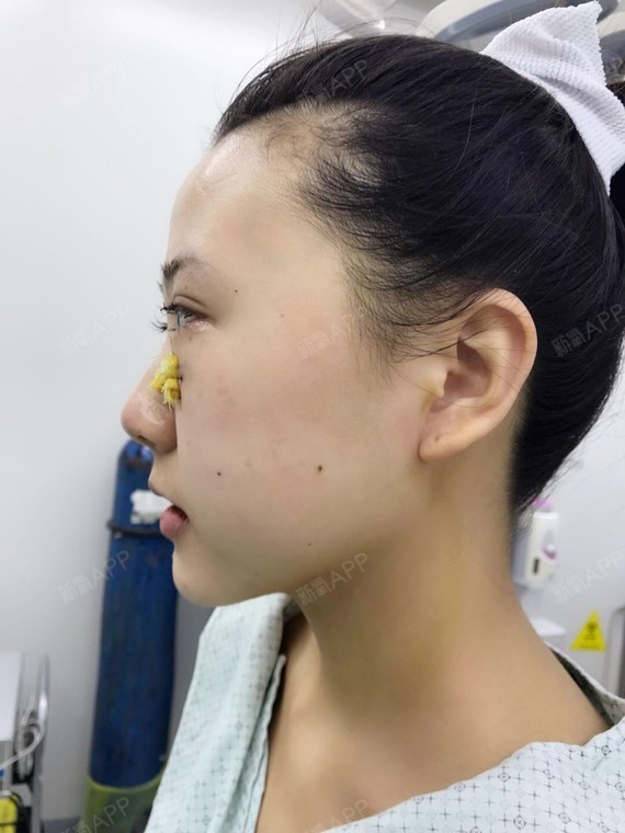 眶隔脂肪释放好不好_效果图_田田的甜甜眶隔脂肪释放术后第0天_新氧
