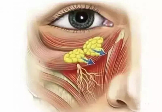 主要是皮肤,眼轮匝肌及眶隔松弛,造成眶隔脂肪由于重力作用脱垂