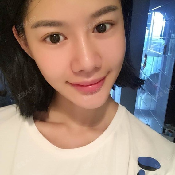 新氧- 一路向北11 | 眼部 | 双眼皮 | 切开双眼皮 | 术后当自强