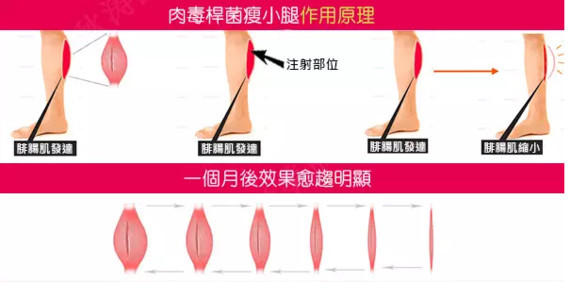 首页 此页面仅支持预览 Avatar 南昌大学医疗美容 500篇日记 瘦脸针专业名称为肉毒素 英文 名为botox 是作用于支配神经的肌肉 其他部位是不起作用的 但是瘦脸针也不是一针下去脸就全瘦了 是要分点注射 协调收紧不协调的肌肉组织 玻尿酸也是透明