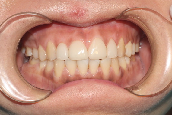 新氧- 氧气xuc9w | 牙齿 | 全瓷牙 | 术后当自强 | 北京同城