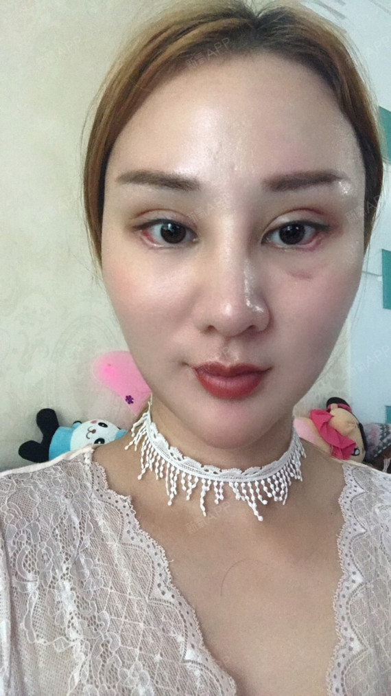 【深圳兰乔-下眼下至术】在兰乔做的下眼下至术今天已经拆线了