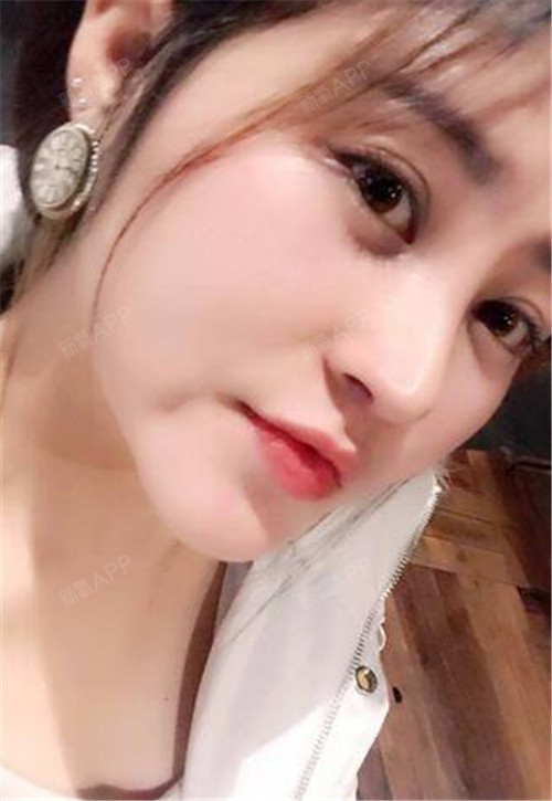 鼻子的各个角度恢复得都比较自然,朋友们说我低头都能_圈子-新氧美容
