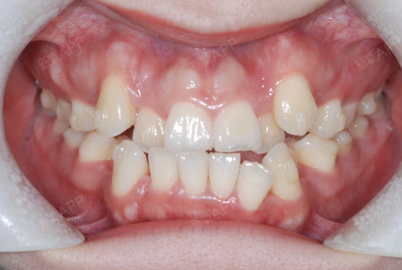 今天复查的又拍了下牙齿的照篇看看牙齿移动的情况~虽_圈子-新氧美容