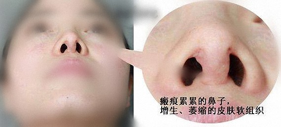 组织处于一种缺血状态,使用的抗生素能达到鼻子内部的有效浓度很低